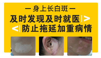 伍德灯检查准不准