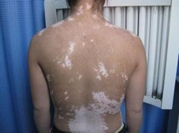 背部的皮肤白斑治疗需要注意什么